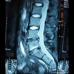 pre-op:discopatia L4-L5-S1